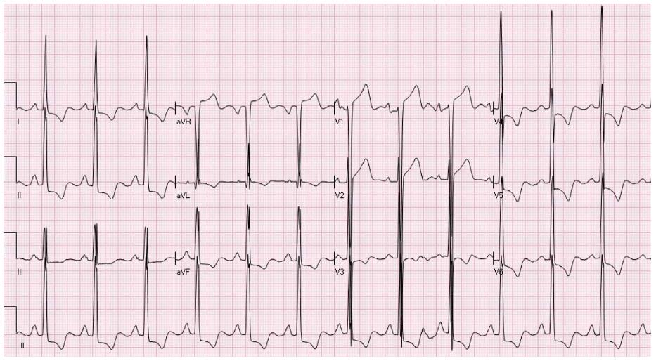 12-lead ECG showing anterior ST-elevation in V2–V4